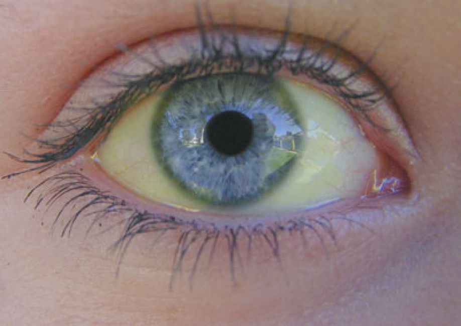 Пожелтение глаз при гепатите фото